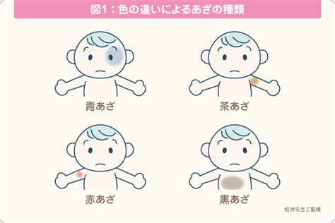 痣種類|あざの種類とは？あざの特徴と治療法を医師がわかり。